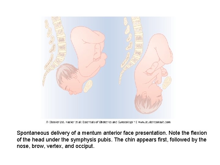 Spontaneous delivery of a mentum anterior face presentation. Note the flexion of the head