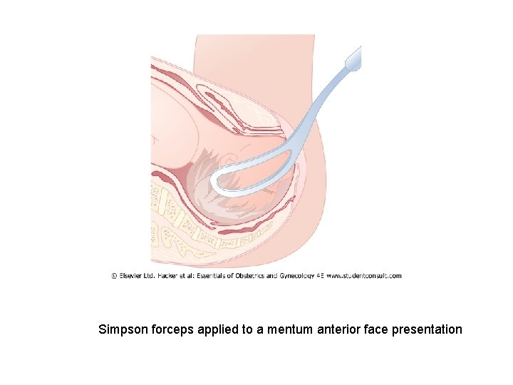 Simpson forceps applied to a mentum anterior face presentation 