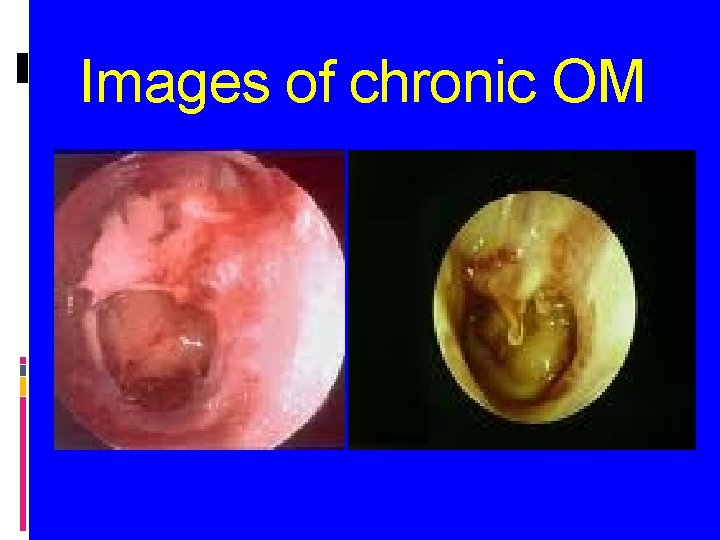 Images of chronic OM 