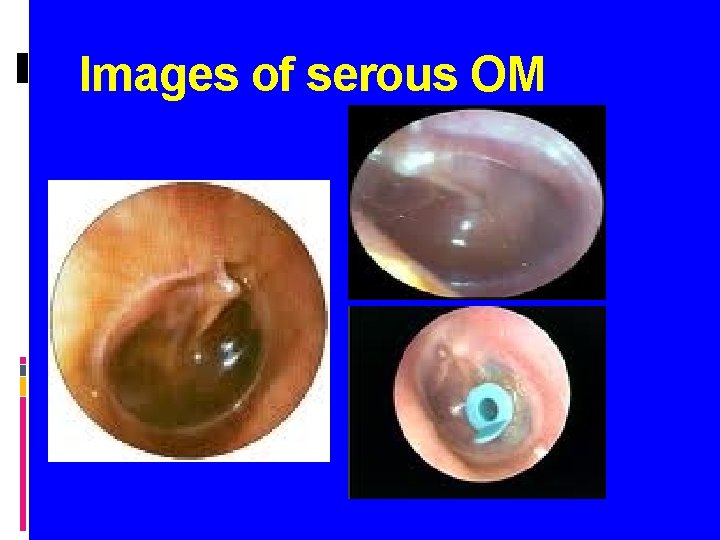 Images of serous OM 