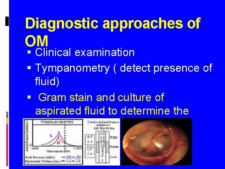 Diagnostic approaches of OM Clinical examination Tympanometry ( detect presence of fluid) Gram stain