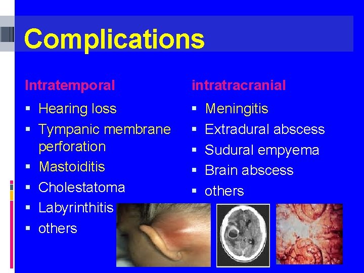 Complications Intratemporal intratracranial Hearing loss Tympanic membrane perforation Mastoiditis Cholestatoma Labyrinthitis others Meningitis Extradural