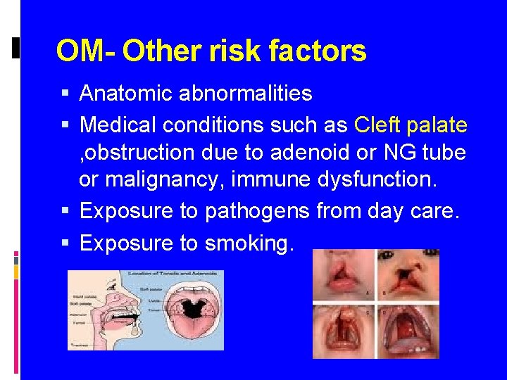 OM- Other risk factors Anatomic abnormalities Medical conditions such as Cleft palate , obstruction
