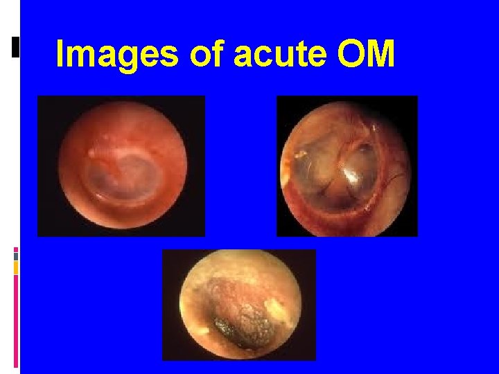 Images of acute OM 