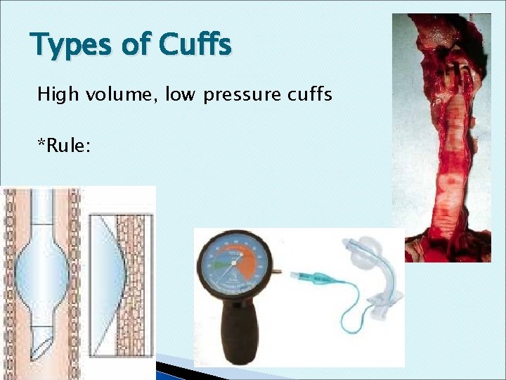 Types of Cuffs High volume, low pressure cuffs *Rule: 