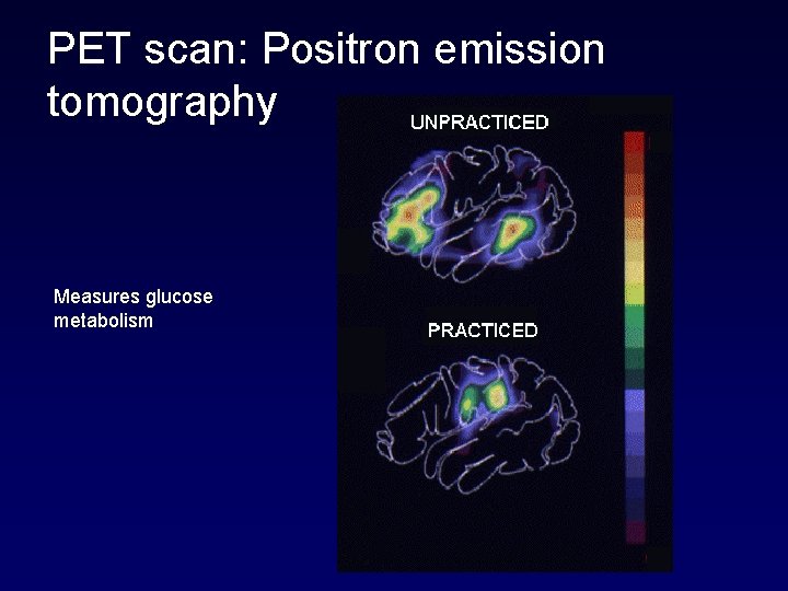 PET scan: Positron emission tomography Measures glucose metabolism 