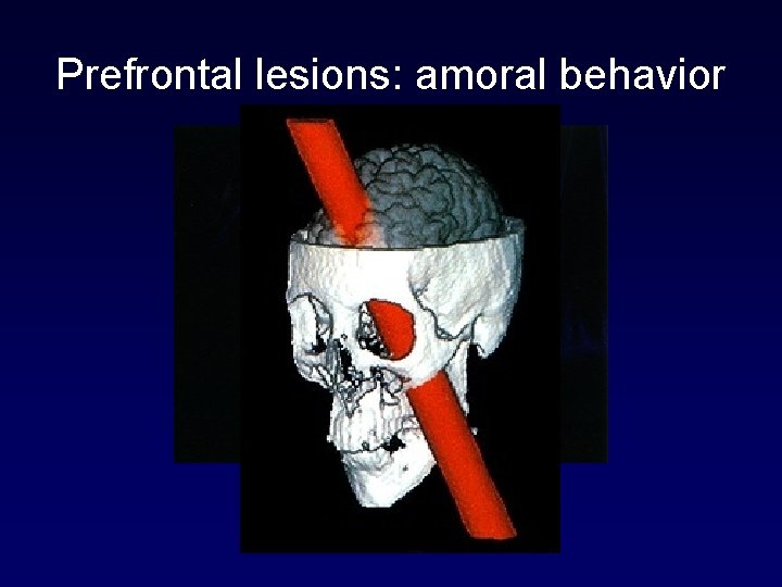 Prefrontal lesions: amoral behavior Phineas Gage 