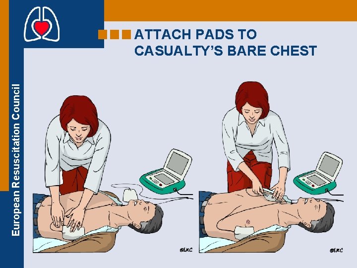European Resuscitation Council ATTACH PADS TO CASUALTY’S BARE CHEST 