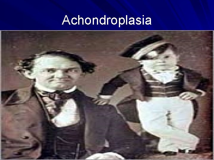 Achondroplasia 