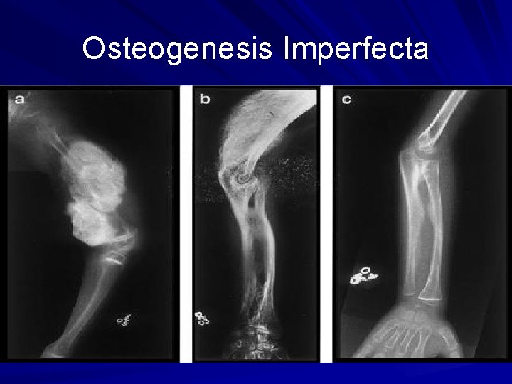 Osteogenesis Imperfecta 