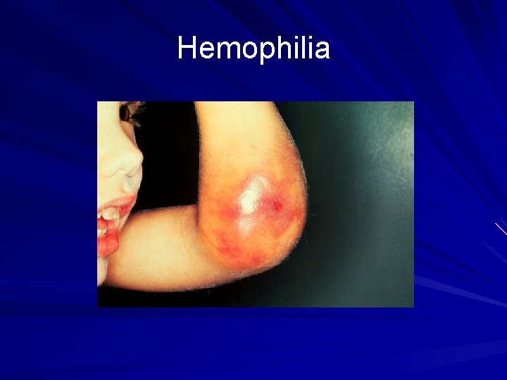 Hemophilia 