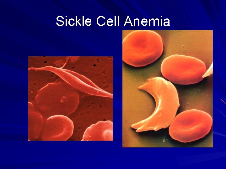 Sickle Cell Anemia 