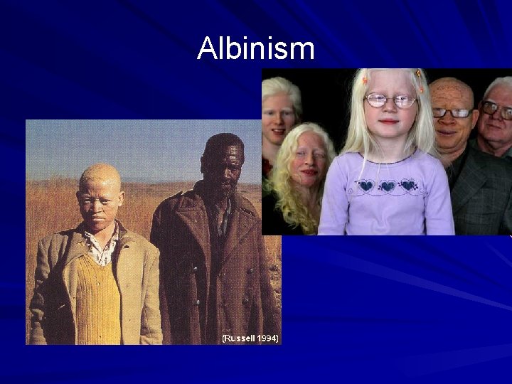 Albinism 