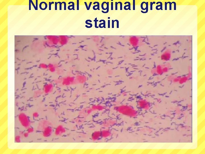 Normal vaginal gram stain 