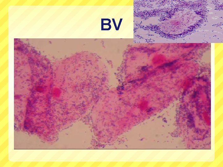 BV 