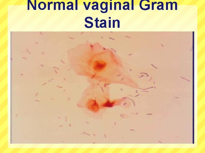 Normal vaginal Gram Stain 