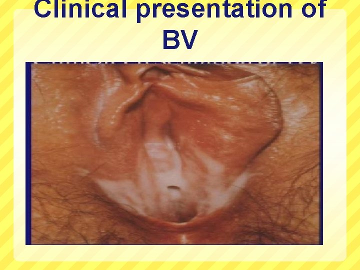 Clinical presentation of BV 