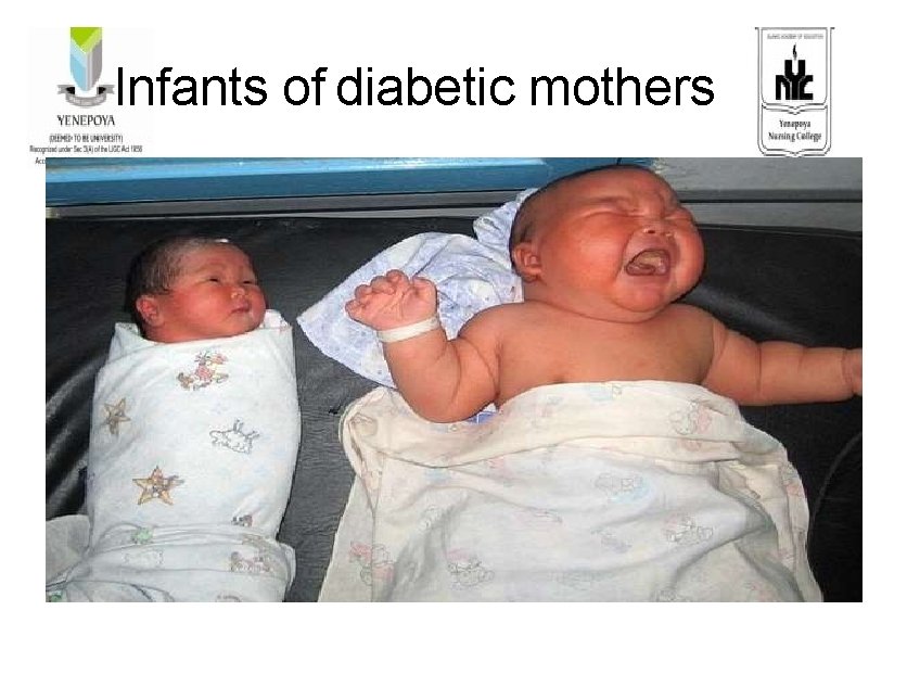 Infants of diabetic mothers 