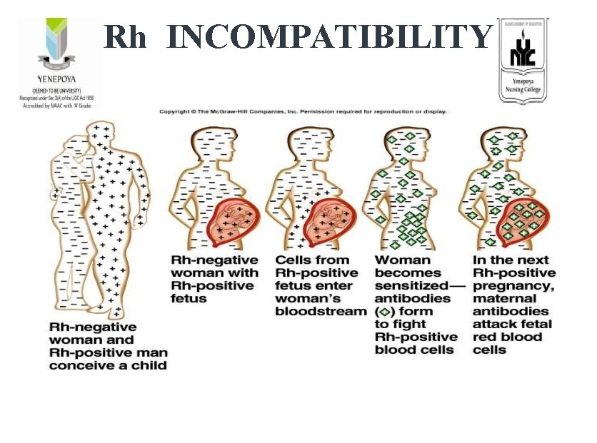 Rh INCOMPATIBILITY 