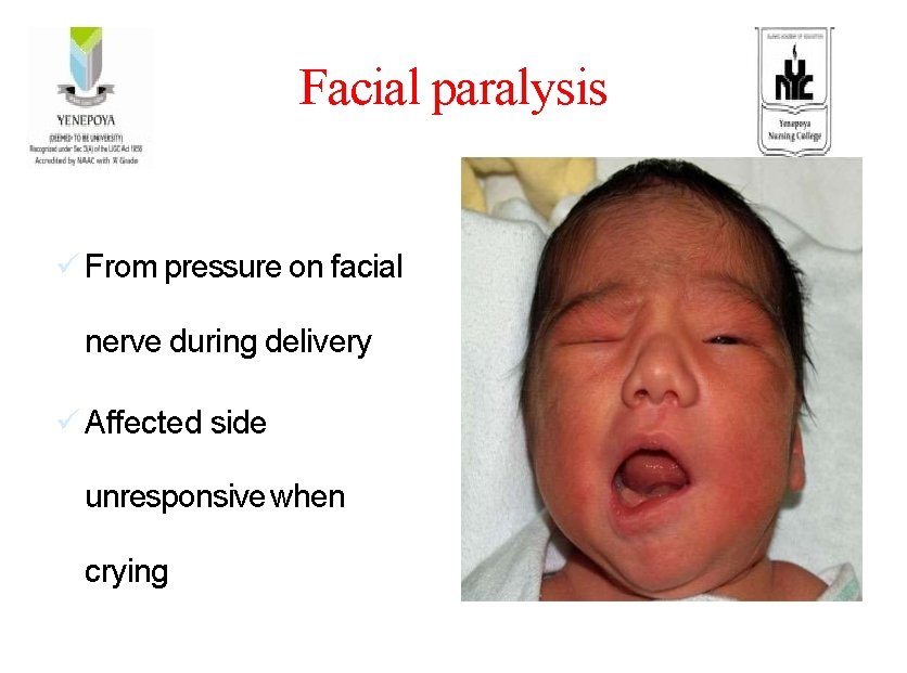 Facial paralysis ü From pressure on facial nerve during delivery ü Affected side unresponsive