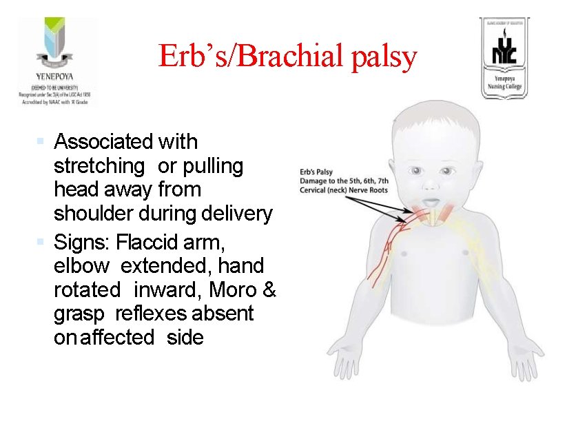 Erb’s/Brachial palsy Associated with stretching or pulling head away from shoulder during delivery Signs: