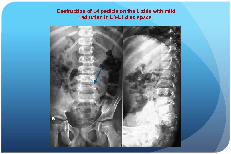 Destruction of L 4 pedicle on the L side with mild reduction in L