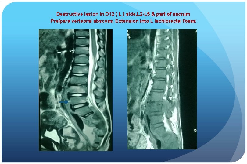 Destructive lesion in D 12 ( L ) side, L 2 -L 5 &