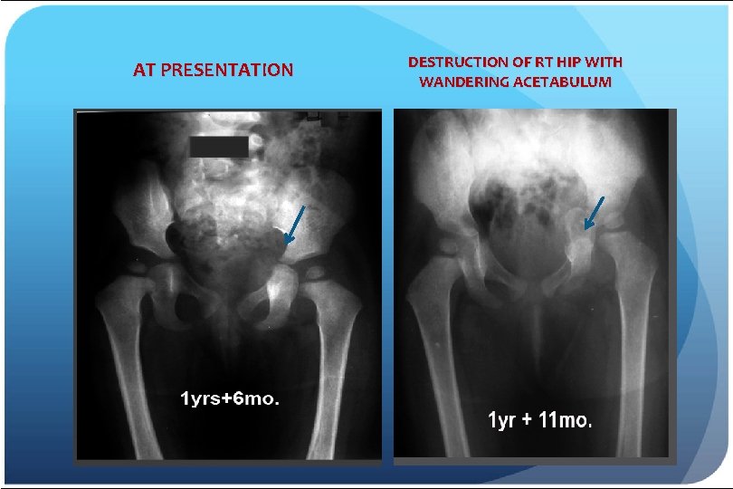 AT PRESENTATION DESTRUCTION OF RT HIP WITH WANDERING ACETABULUM 