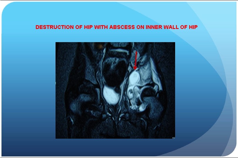 DESTRUCTION OF HIP WITH ABSCESS ON INNER WALL OF HIP 