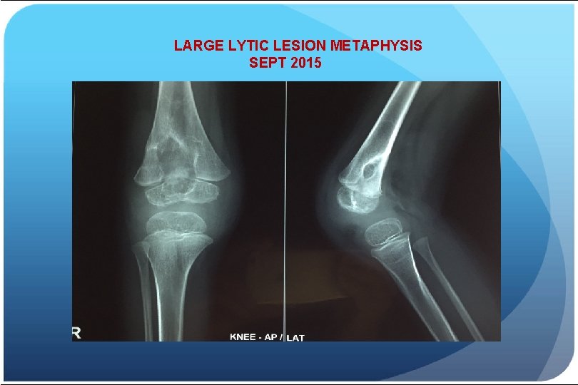LARGE LYTIC LESION METAPHYSIS SEPT 2015 