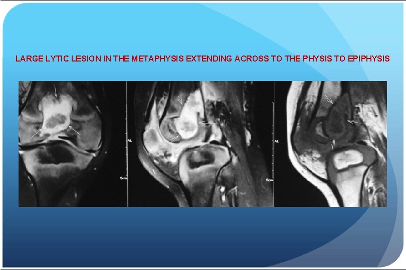 LARGE LYTIC LESION IN THE METAPHYSIS EXTENDING ACROSS TO THE PHYSIS TO EPIPHYSIS 