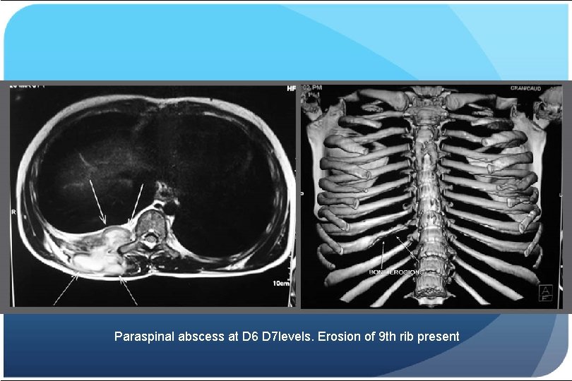 Paraspinal abscess at D 6 D 7 levels. Erosion of 9 th rib present