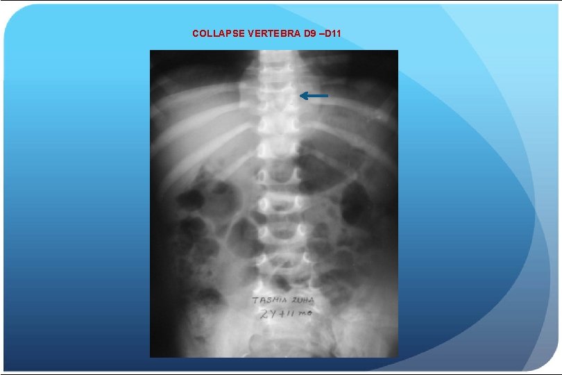 COLLAPSE VERTEBRA D 9 –D 11 