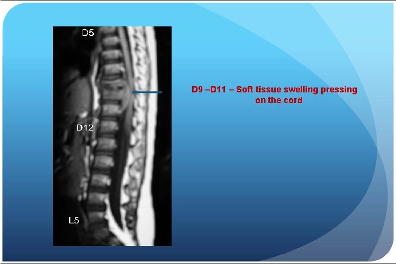 D 9 –D 11 – Soft tissue swelling pressing on the cord 
