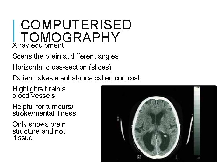 COMPUTERISED TOMOGRAPHY X-ray equipment Scans the brain at different angles Horizontal cross-section (slices) Patient