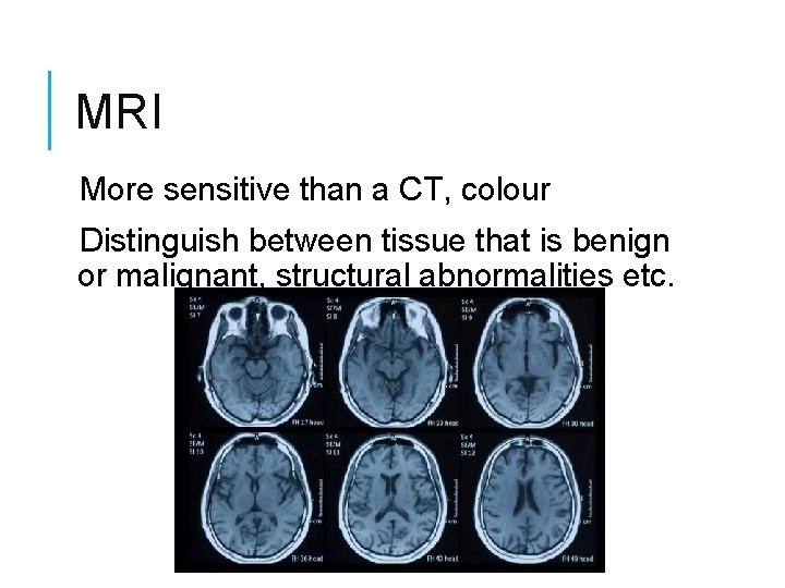 MRI More sensitive than a CT, colour Distinguish between tissue that is benign or