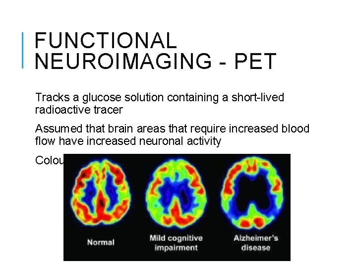 FUNCTIONAL NEUROIMAGING - PET Tracks a glucose solution containing a short-lived radioactive tracer Assumed