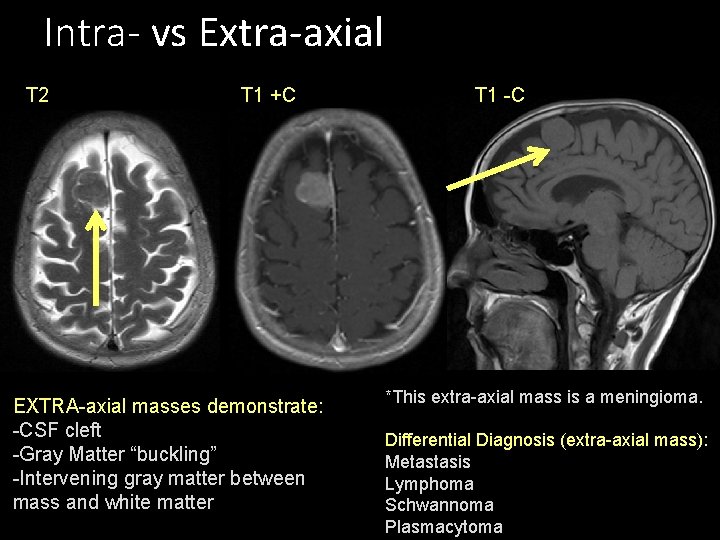 Intra- vs Extra-axial T 2 T 1 +C EXTRA-axial masses demonstrate: -CSF cleft -Gray