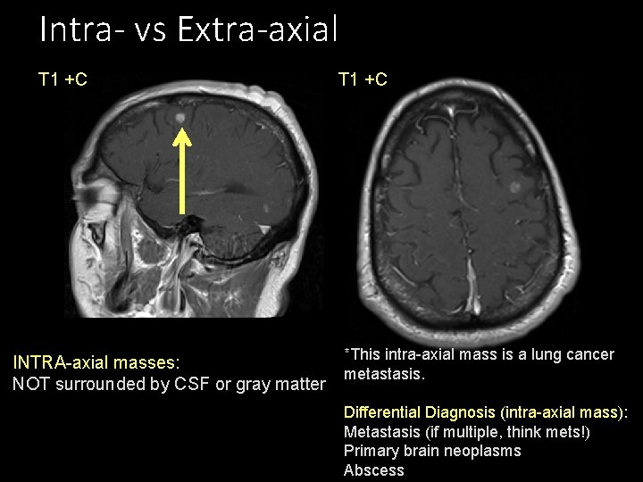 Intra- vs Extra-axial T 1 +C INTRA-axial masses: NOT surrounded by CSF or gray