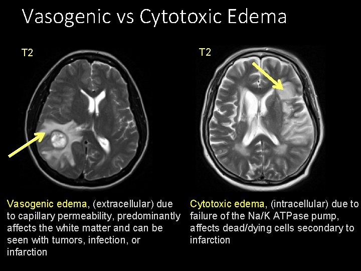Vasogenic vs Cytotoxic Edema T 2 Vasogenic edema, (extracellular) due to capillary permeability, predominantly