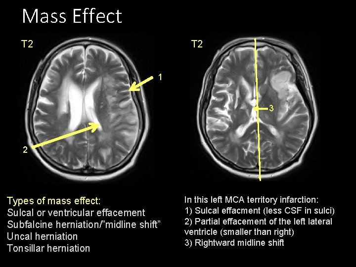 Mass Effect T 2 1 3 2 Types of mass effect: Sulcal or ventricular