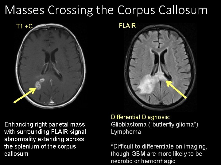 Masses Crossing the Corpus Callosum T 1 +C Enhancing right parietal mass with surrounding