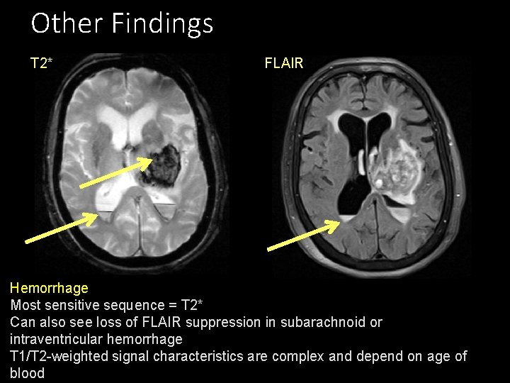 Other Findings T 2* FLAIR Hemorrhage Most sensitive sequence = T 2* Can also