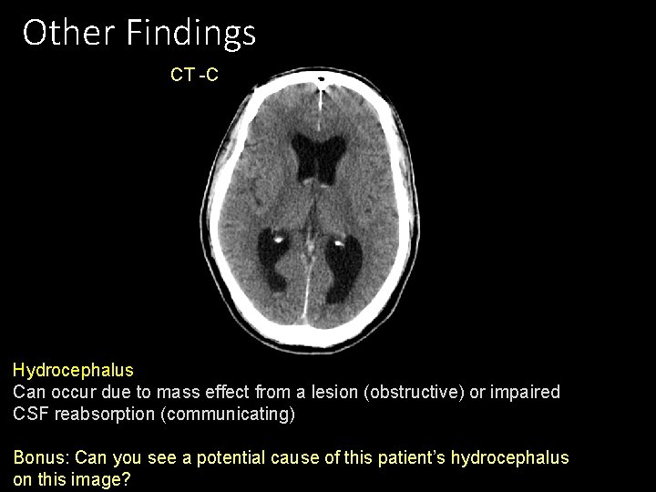 Other Findings CT -C Hydrocephalus Can occur due to mass effect from a lesion