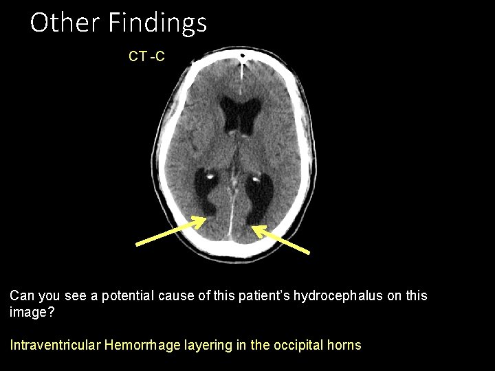 Other Findings CT -C Can you see a potential cause of this patient’s hydrocephalus