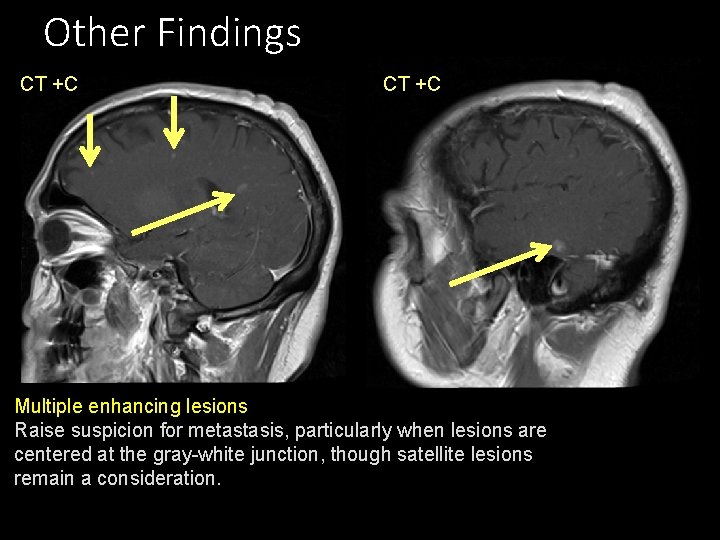 Other Findings CT +C Multiple enhancing lesions Raise suspicion for metastasis, particularly when lesions