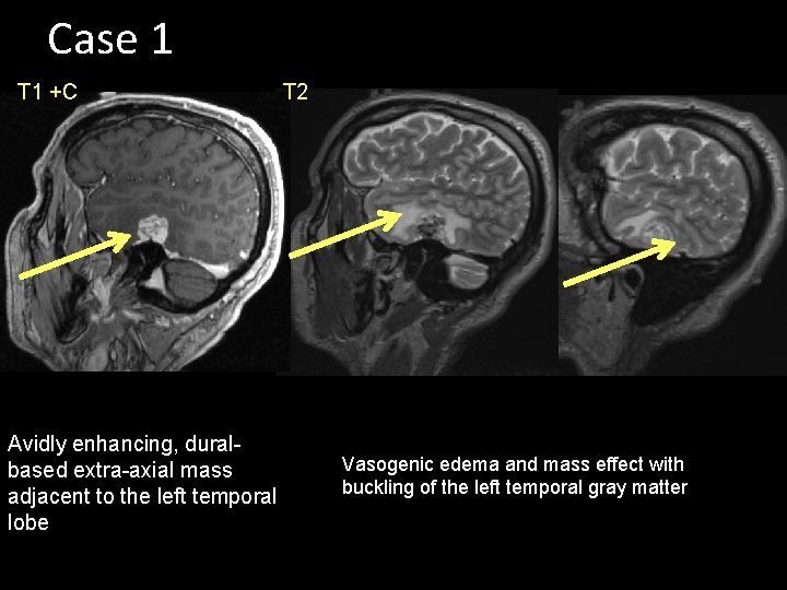 Case 1 T 1 +C Avidly enhancing, duralbased extra-axial mass adjacent to the left