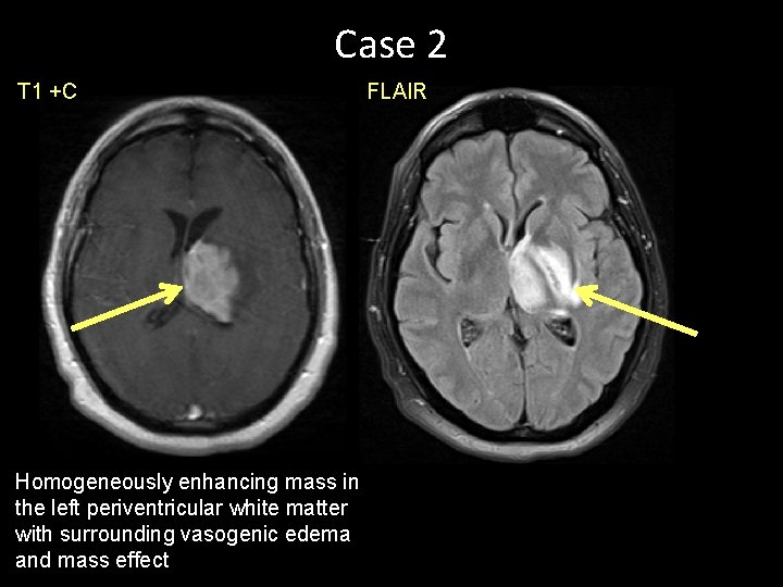 Case 2 T 1 +C Homogeneously enhancing mass in the left periventricular white matter