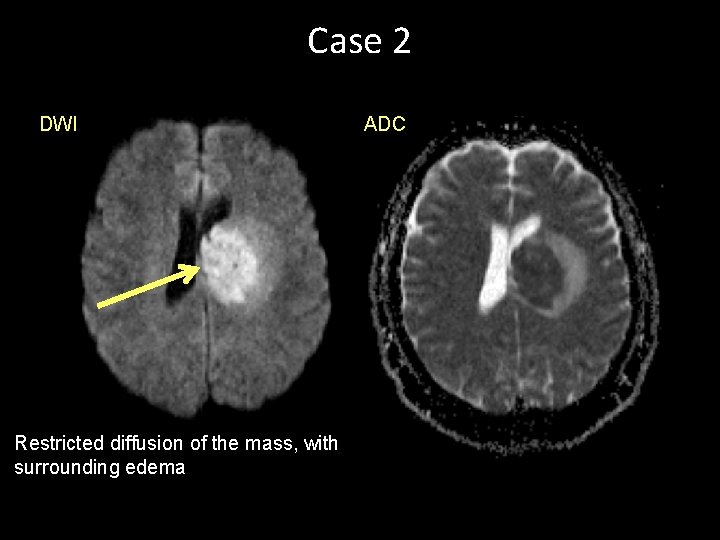 Case 2 DWI Restricted diffusion of the mass, with surrounding edema ADC 
