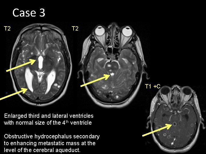 Case 3 T 2 T 1 +C Enlarged third and lateral ventricles with normal